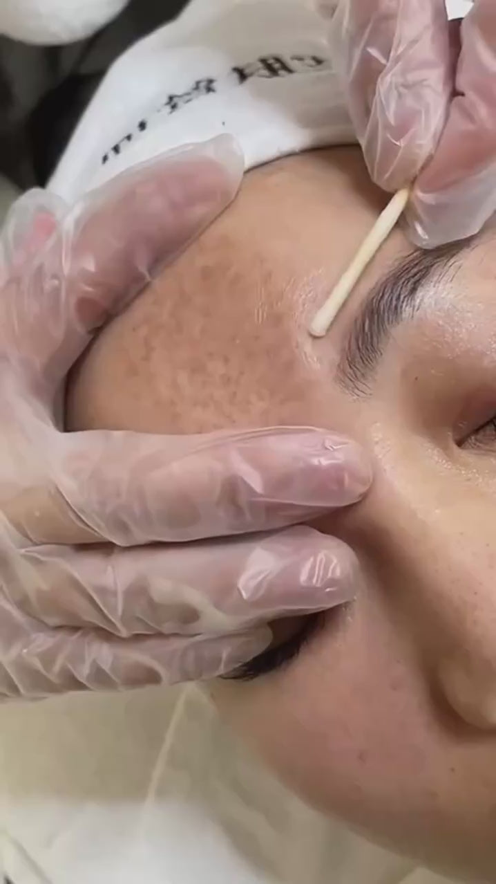 Lighten Freckles Melasma, Facial Dark Spots